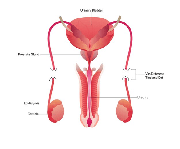 Who gets a vasectomy?