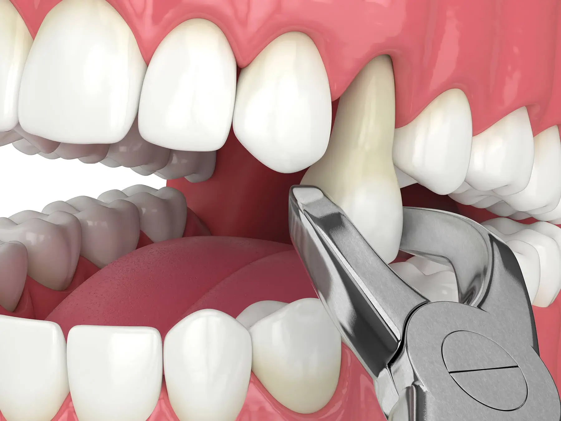 Reasons to Have a Tooth Pulled