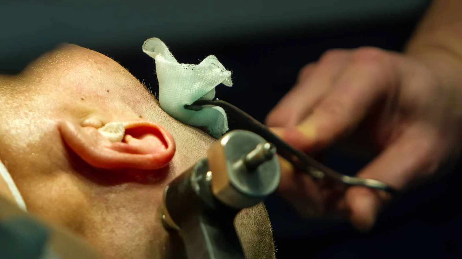 Why is Myringotomy performed?