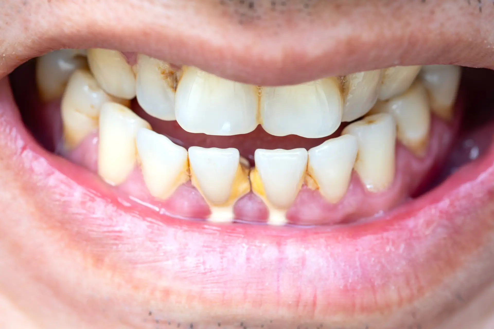 What is Gum Disease?