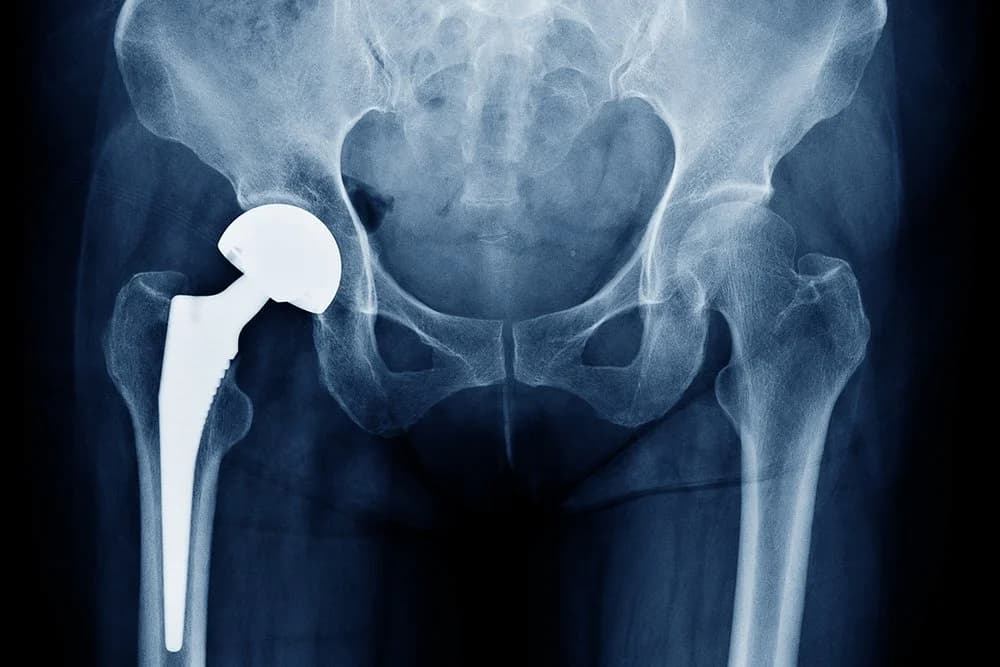 What are the different types of hip replacement surgery?