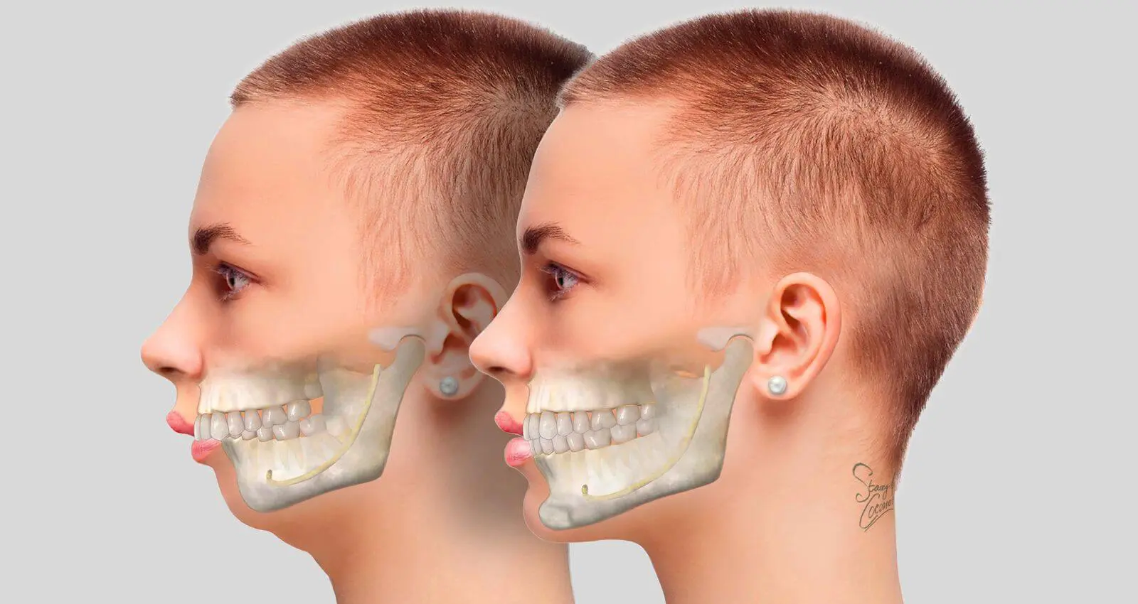 Types of Orthognathic Surgery