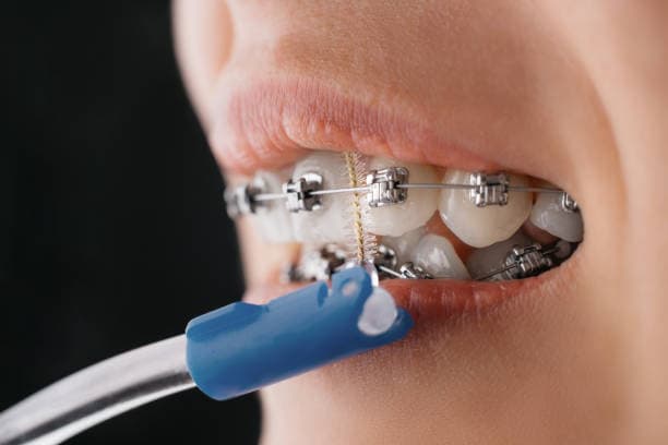 Orthodontic Appliance Types