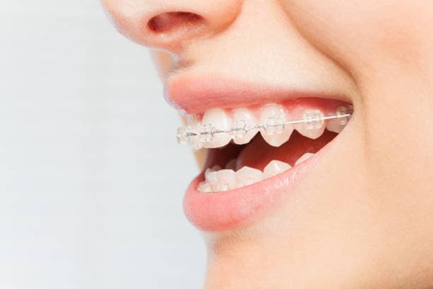 Clear aligners