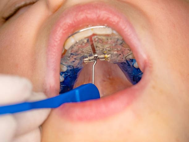 Palatal expanders
