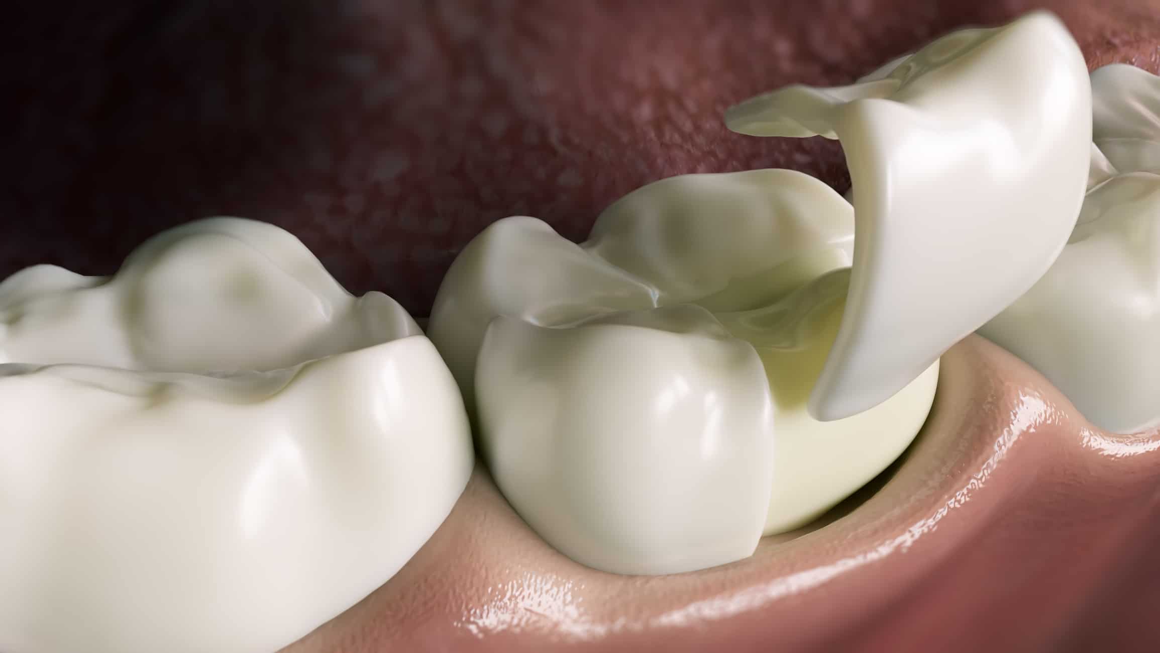 What is dental bonding?