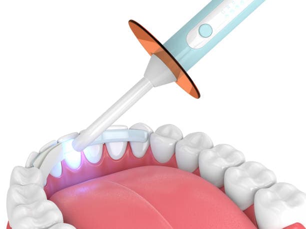 When is dental bonding recommended?