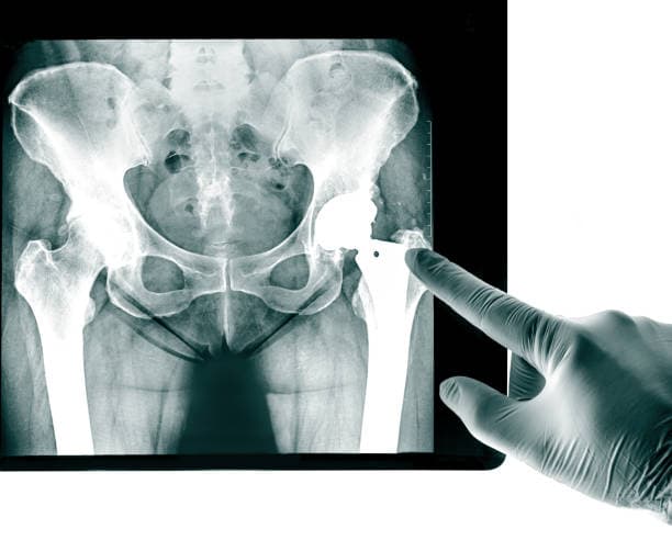 Who needs a joint replacement surgery?