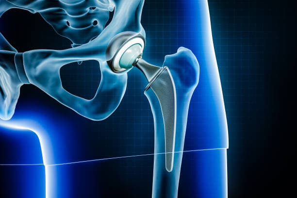 Joint replacement recovery