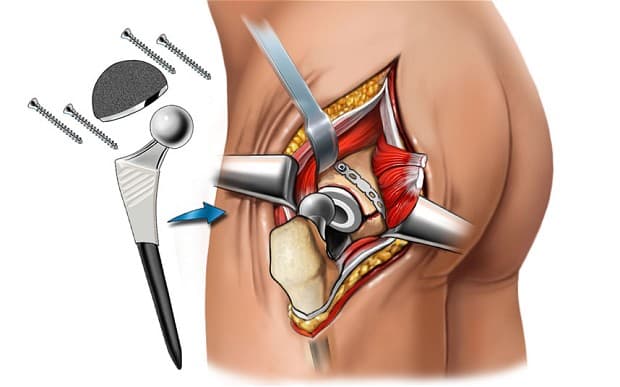 What Is Hip Replacement Surgery?
