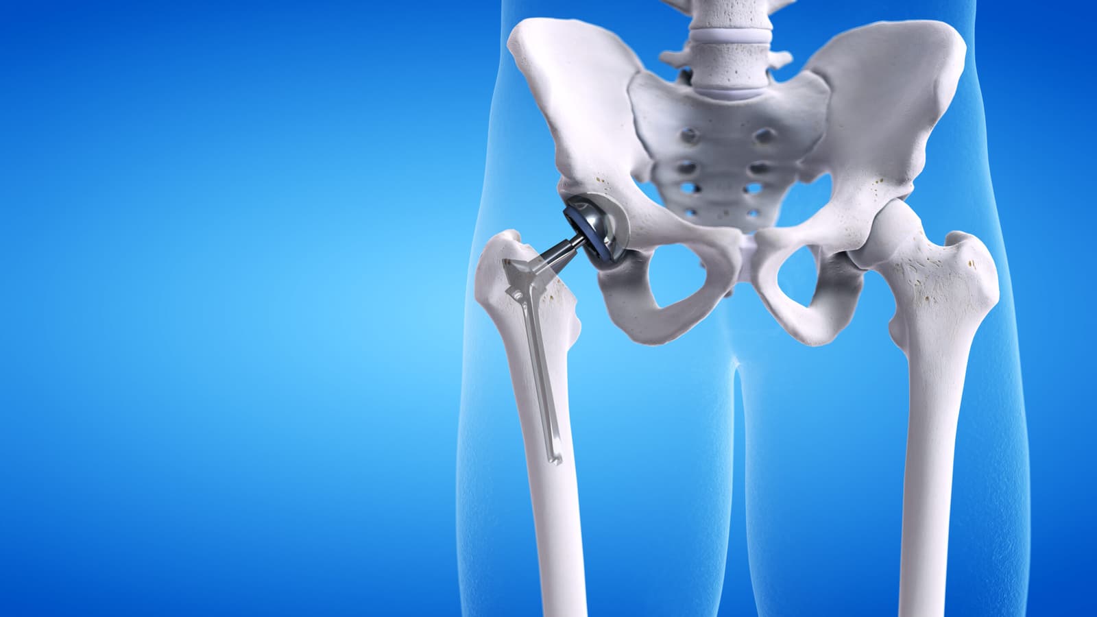 Hip Replacement Surgery Risks