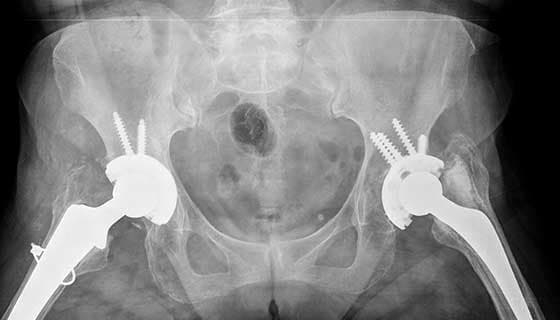 Hip Replacement Surgery recovery