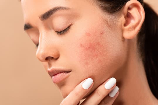 Acne Treatment