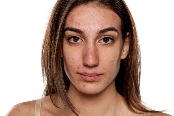 What is Acne?