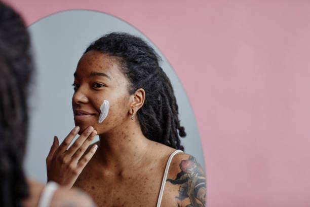 What are the symptoms of acne?