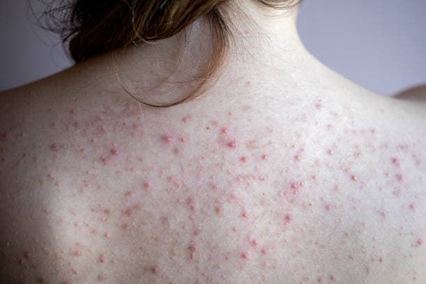 How is acne diagnosed?
