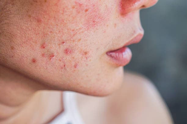 How is acne treated?