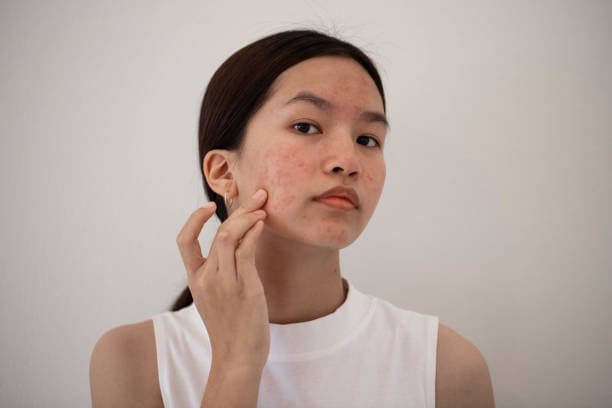 How to prevent acne?