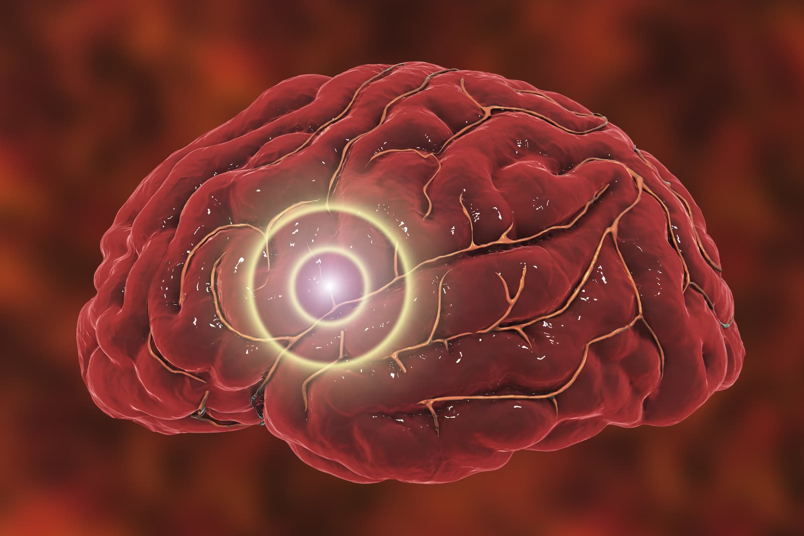 What blood vessels do cerebrovascular diseases affect?