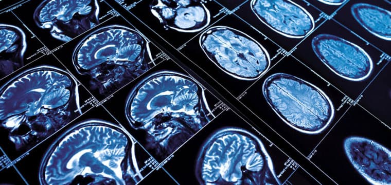 How can I reduce my risk of cerebrovascular disease?