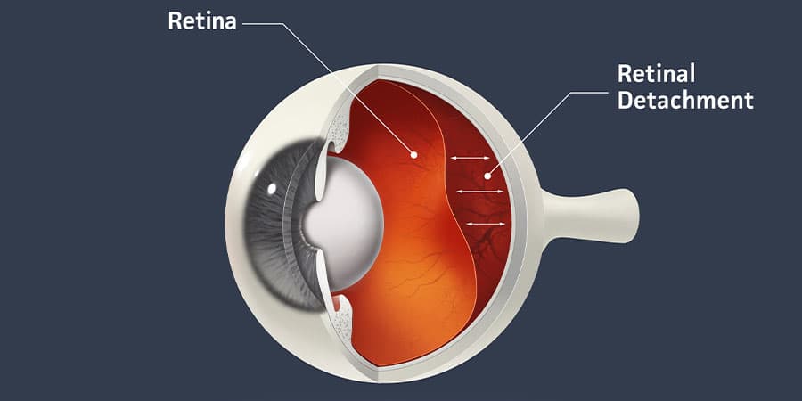 What is retinal detachment?