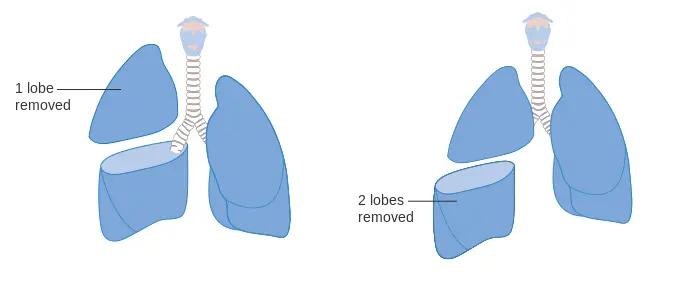 Lobectomy procedure steps