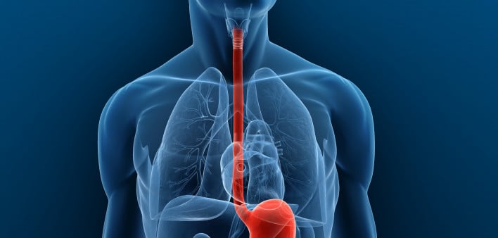What is an Esophagectomy?