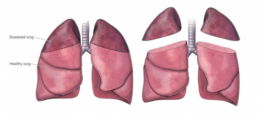 Why is Lung Volume reduction surgery performed?