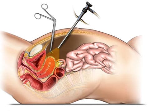 What are Surgical Techniques for Hysterectomy?