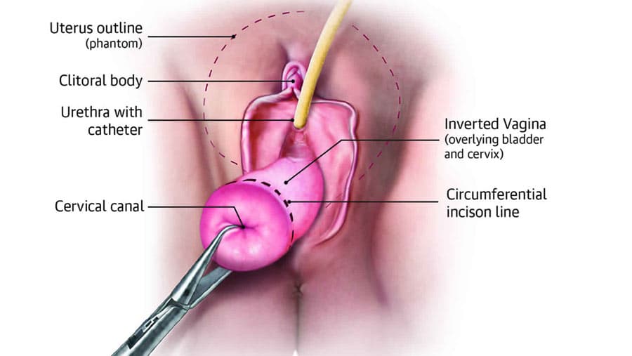 Hysterectomy Pros and Cons