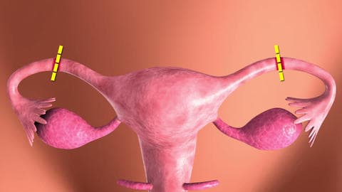 How is female sterilization performed?