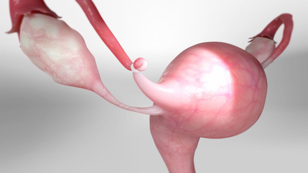 Recovery from female sterilization