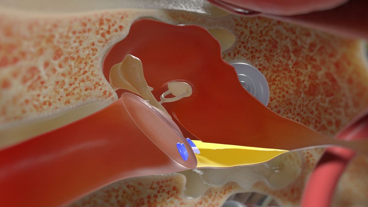 Myringotomy