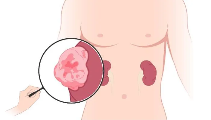 What is pyeloplasty procedure?