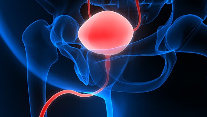 What happens during a cystectomy?