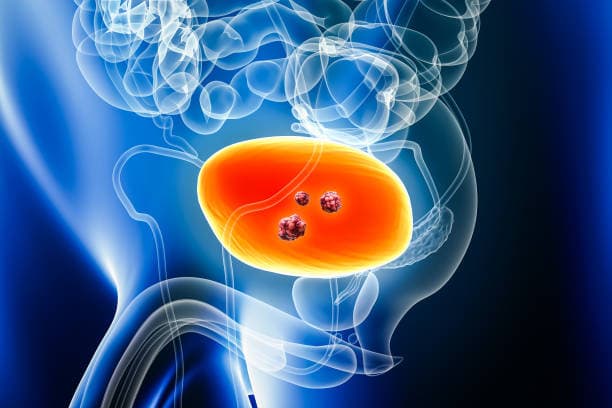 How is life after a cystectomy?