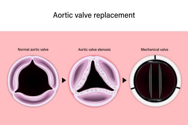 Why would I need a valve replacement?