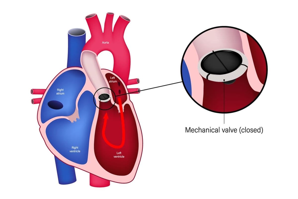 What are the risks of Aortic valve replacement?