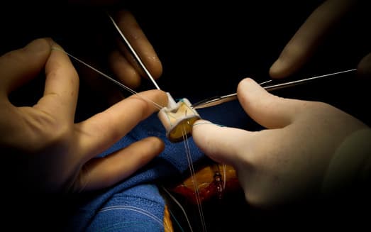What are the types of Aortic valve surgery?