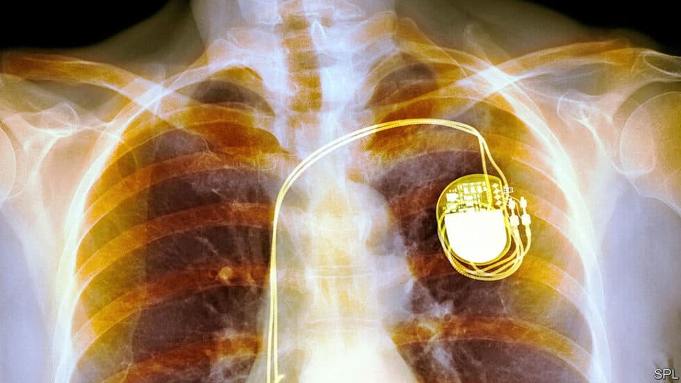 Is pacemaker implantation a major surgery?