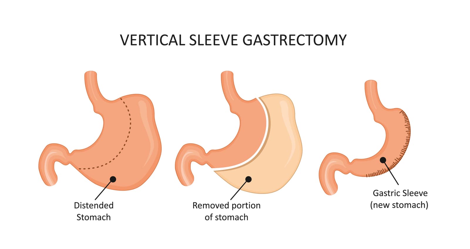 Life after Gastrectomy