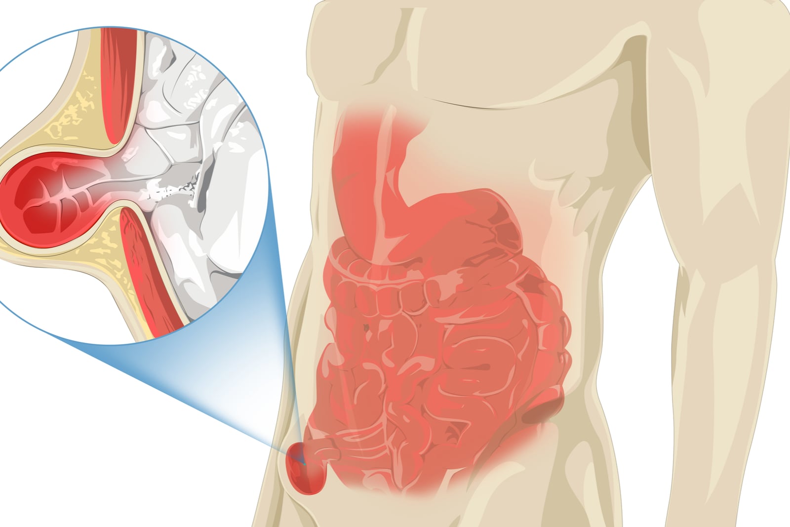 What is a hernia repair surgery?