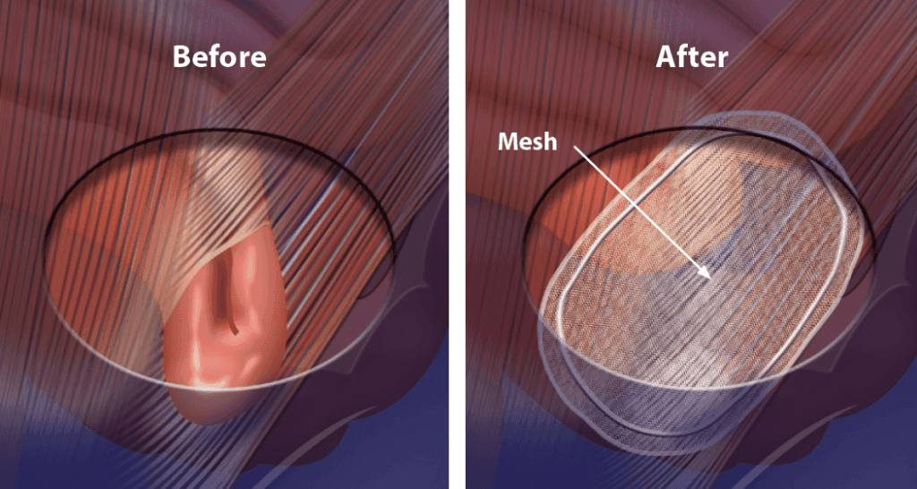 Why would I need a hernia repair?