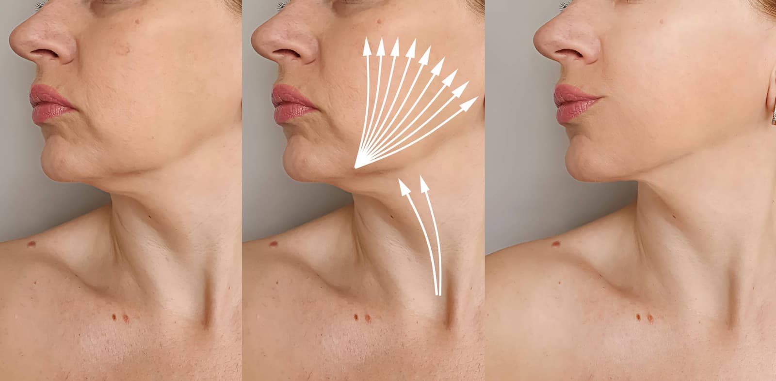 What happens during double chin suction?