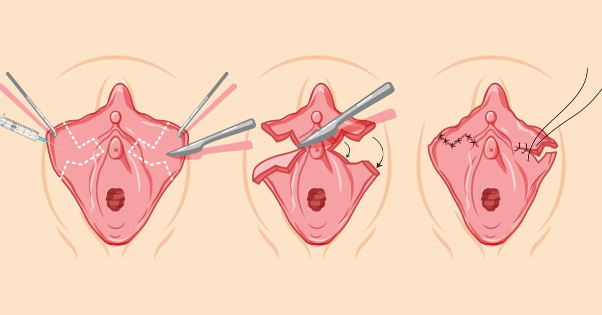 Why would someone get a labiaplasty?