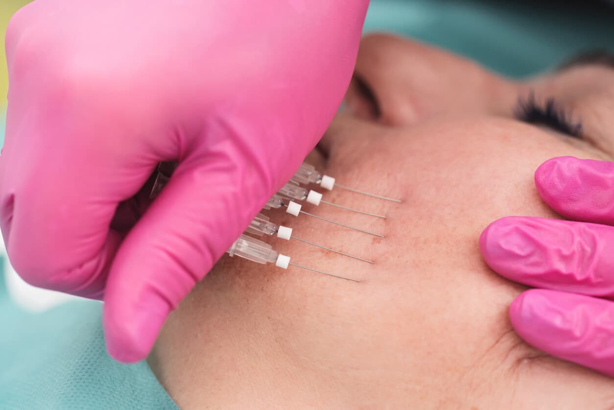 What is a thread lift?