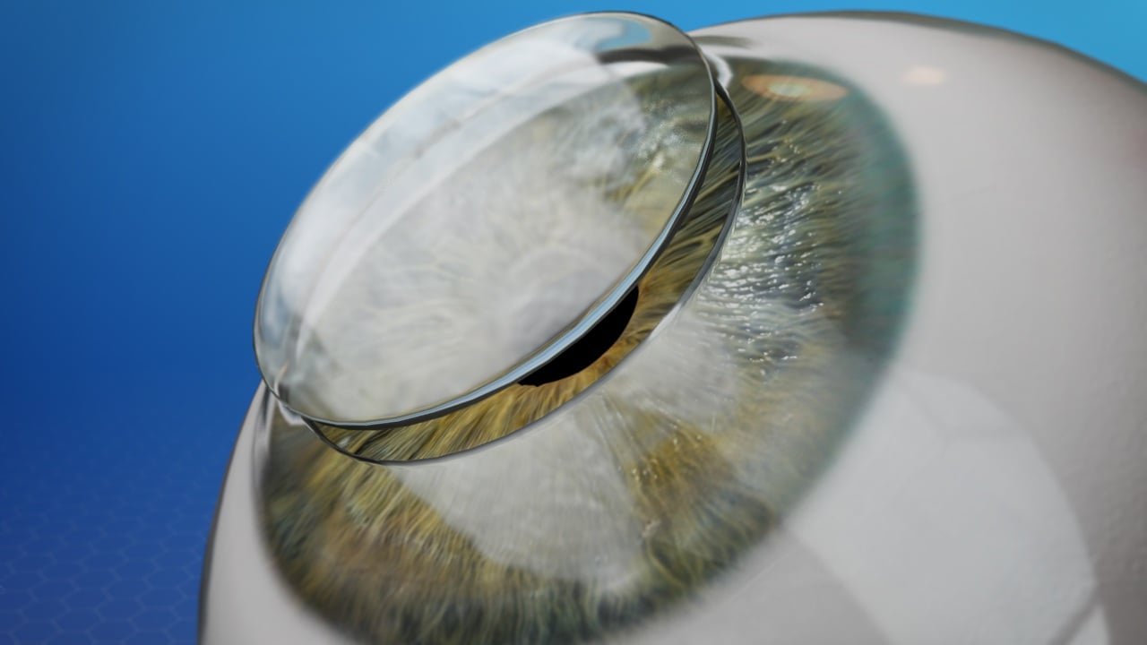 Why would someone need a cornea transplant?