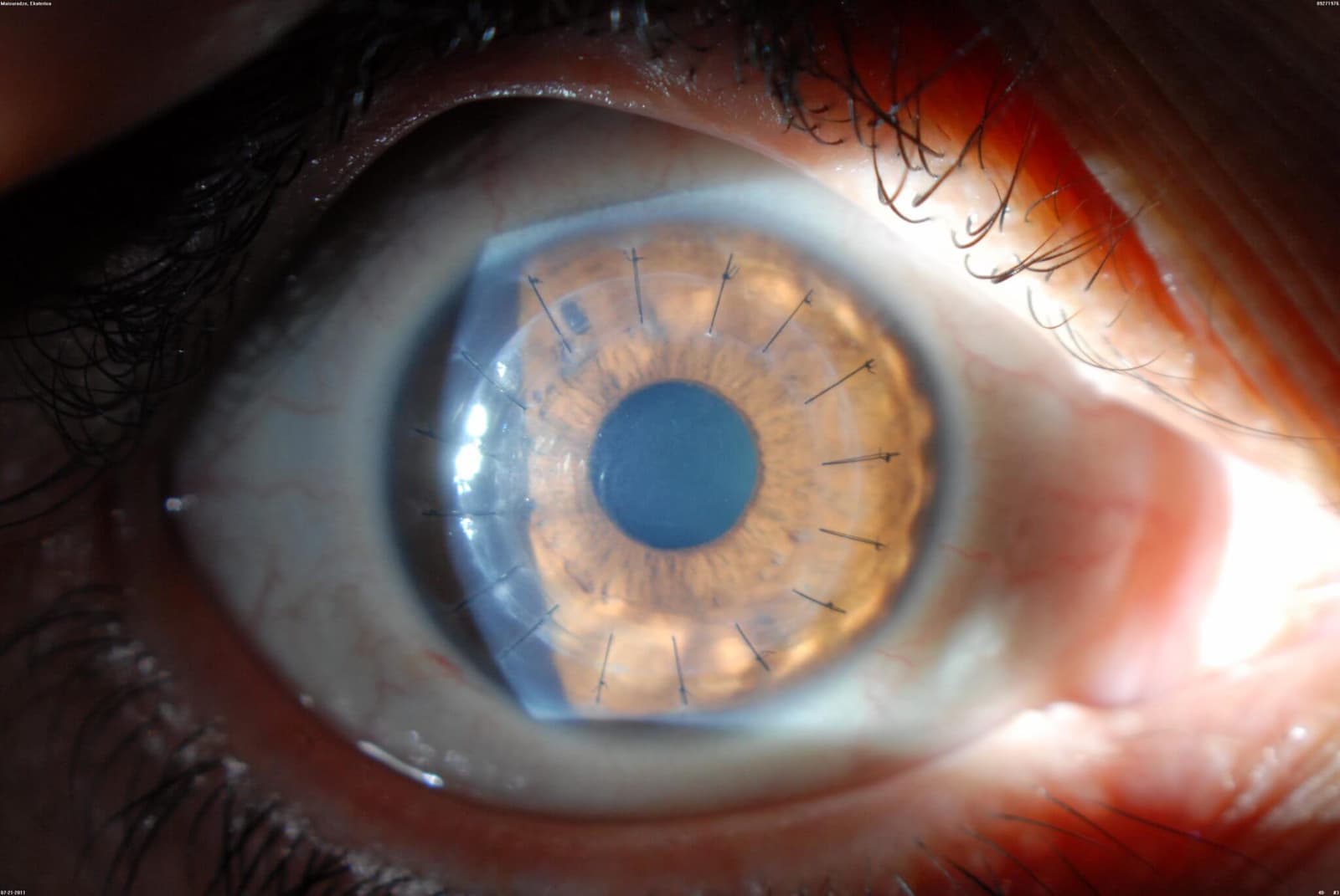 What is a cornea transplant?