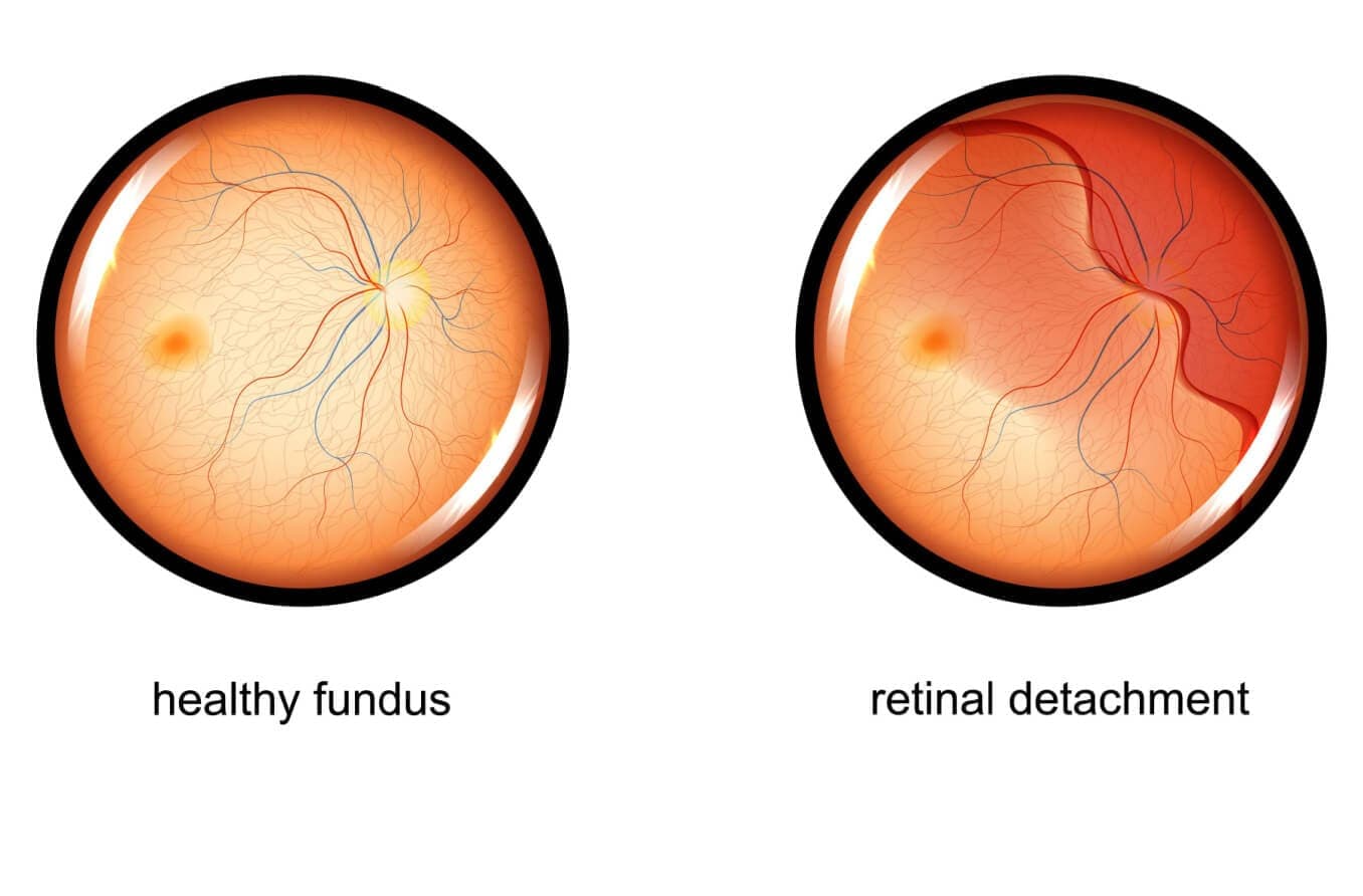 Types of retina surgery