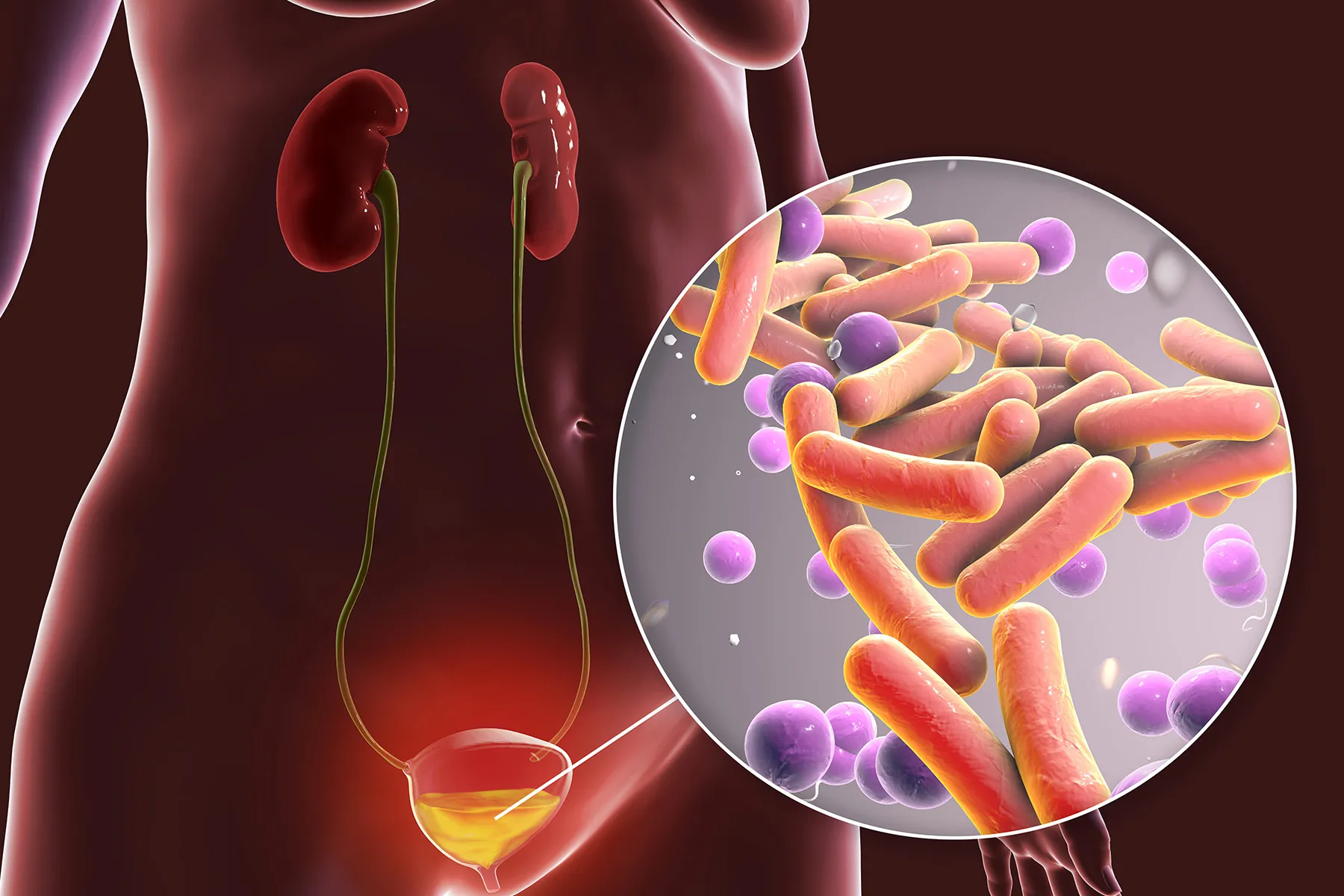 How to avoid Urinary Tract Infections?